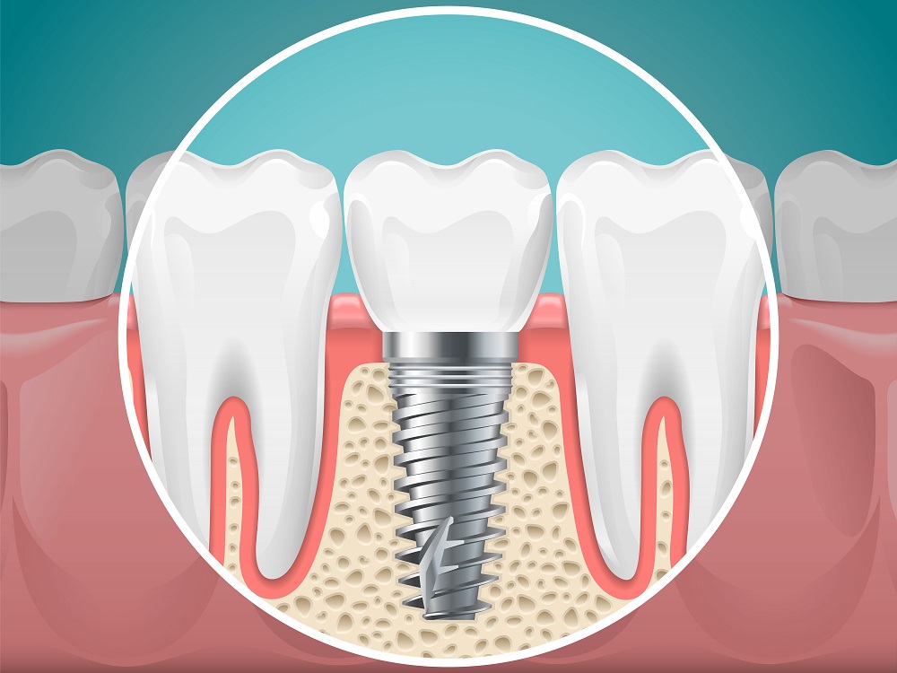 What You Should Know About Dental Implants