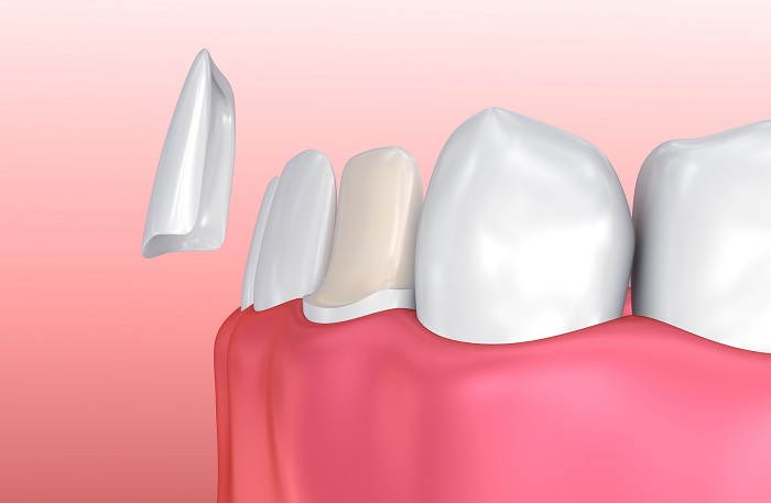 Benefits of Veneers