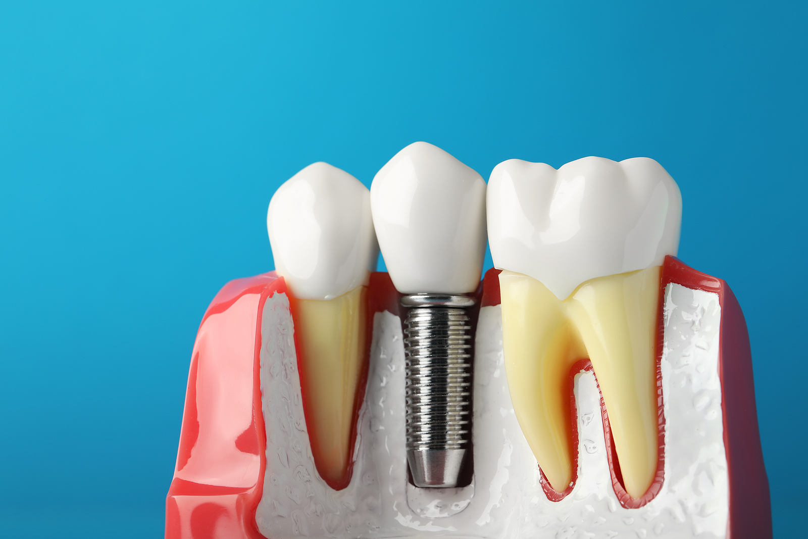 The History of Dental Implants