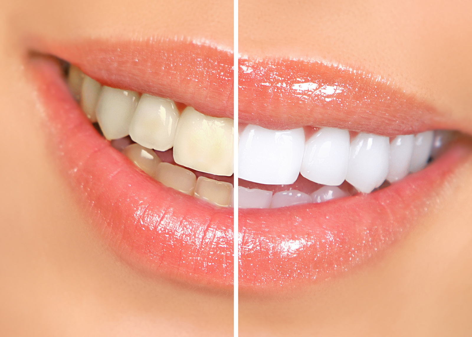 Making the Decision to Have Your Teeth Whitened