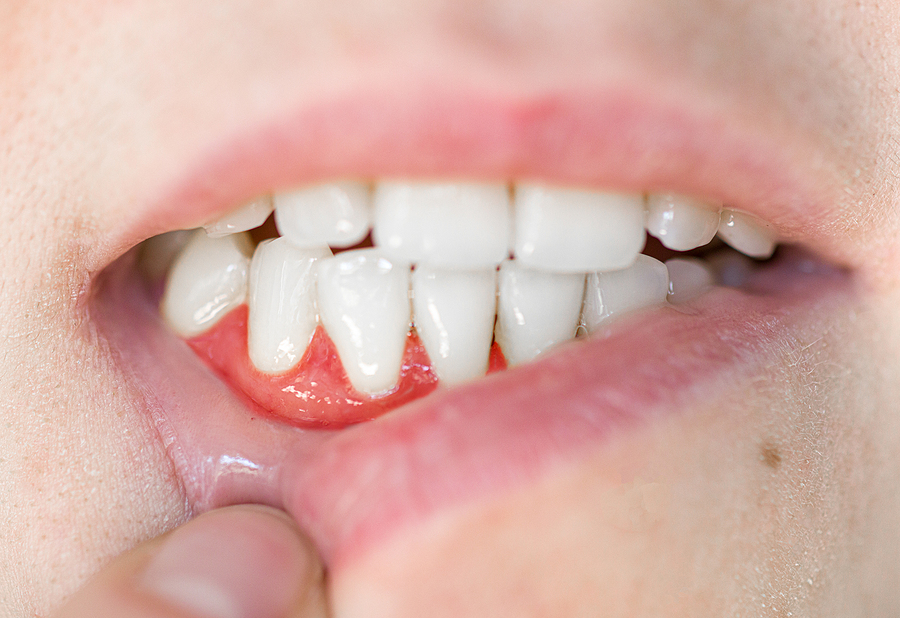 Tooth and Gum Disease: Causes, Symptoms, and Treatment